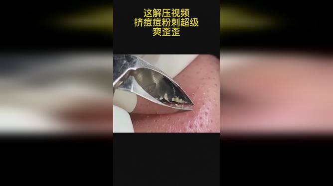 最新擠膿包視頻，見證變化的力量，自信與成就感的誕生之地