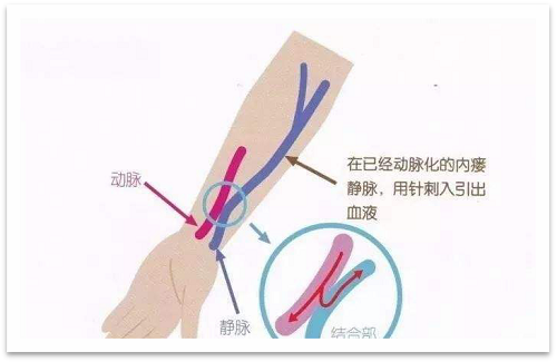 靜脈瘺最新資訊，掌握最前沿的健康信息